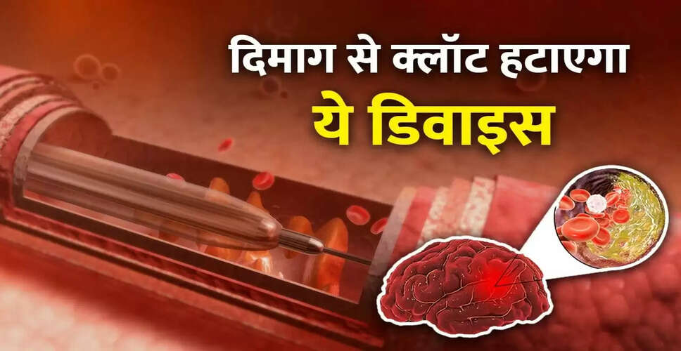 भारतीय वैज्ञानिकों की नई खोज: स्ट्रोक के इलाज के लिए सस्ता डिवाइस
