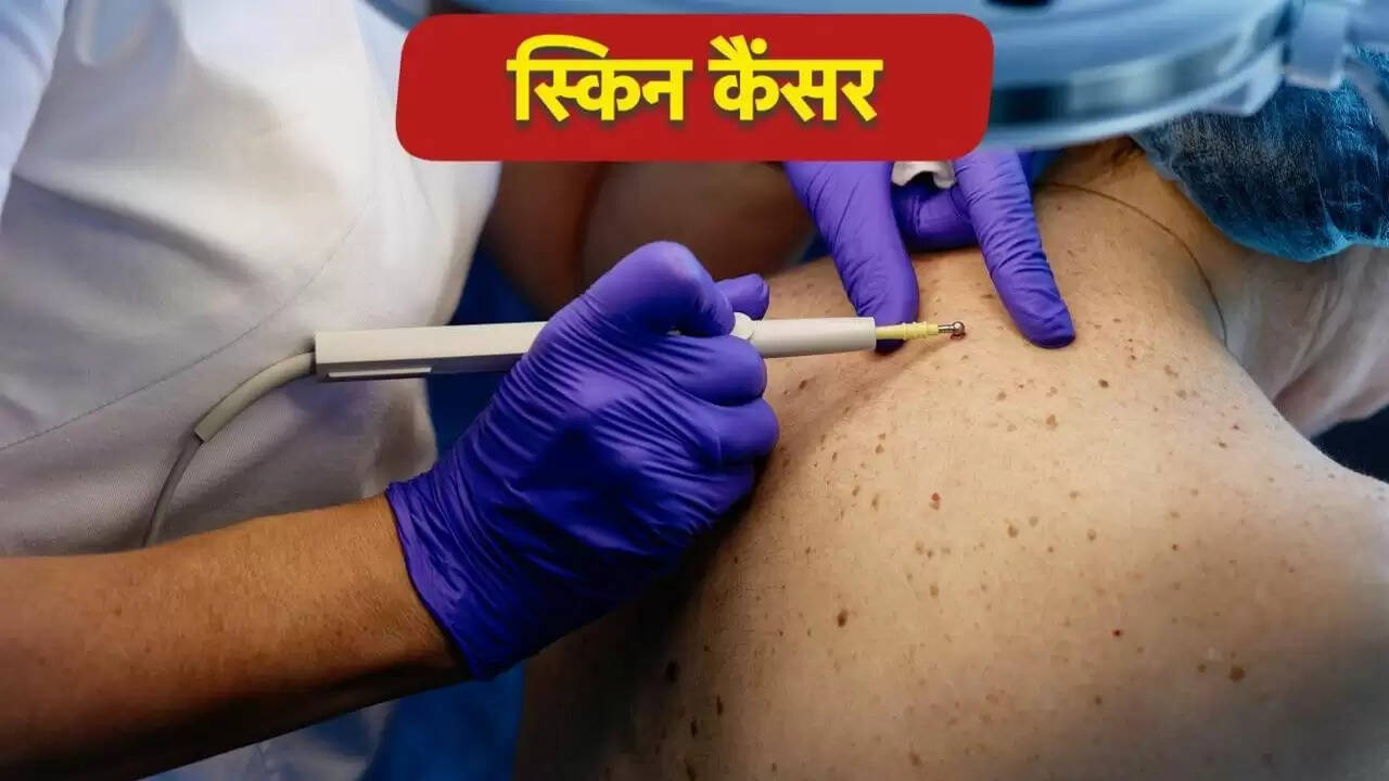 स्किन कैंसर: लक्षण, कारण और बचाव के उपाय