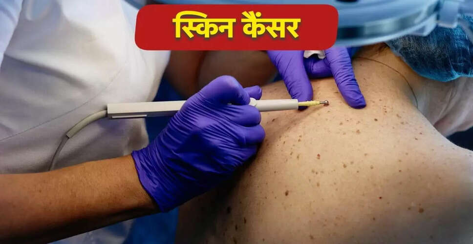स्किन कैंसर: लक्षण, कारण और बचाव के उपाय