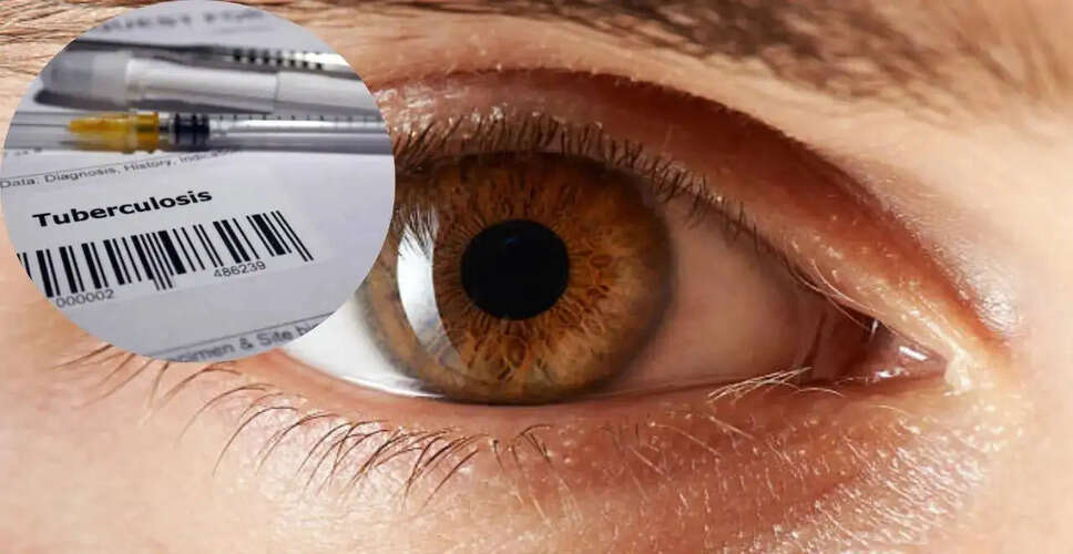 आंखों में तपेदिक: दीर्घकालिक प्रभाव और प्रबंधन