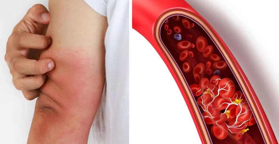 रक्त थक्के के लक्षण: जानें कब करें डॉक्टर से संपर्क