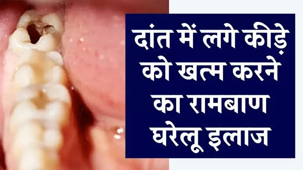 दांतों के कीड़ों से राहत पाने के घरेलू उपाय