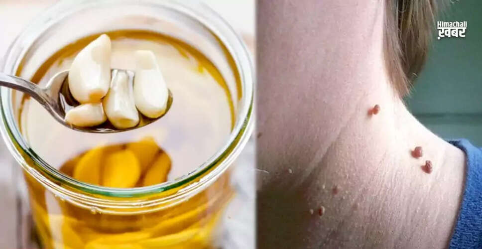 तिल और मस्से हटाने के घरेलू उपाय: लहसुन का जादू
