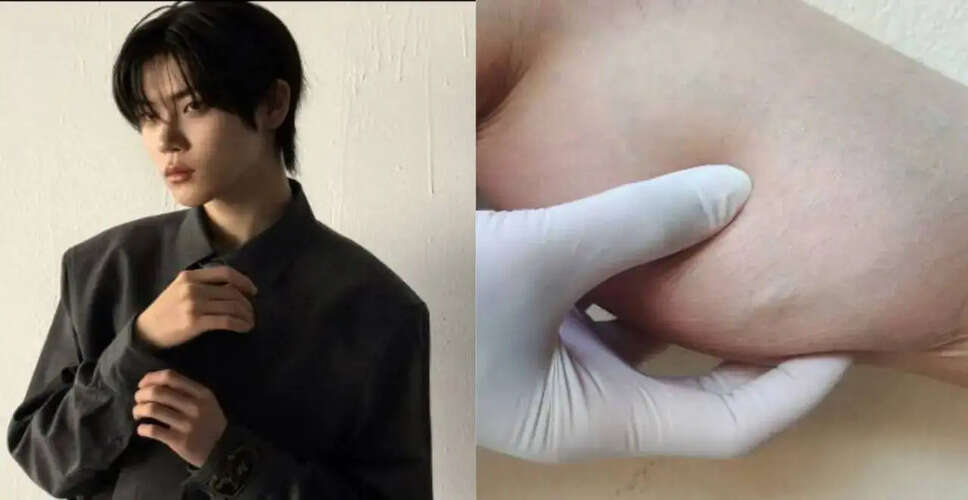 K-Pop आइडल Jang Yeojun को Rhabdomyolysis के कारण अस्पताल में भर्ती किया गया