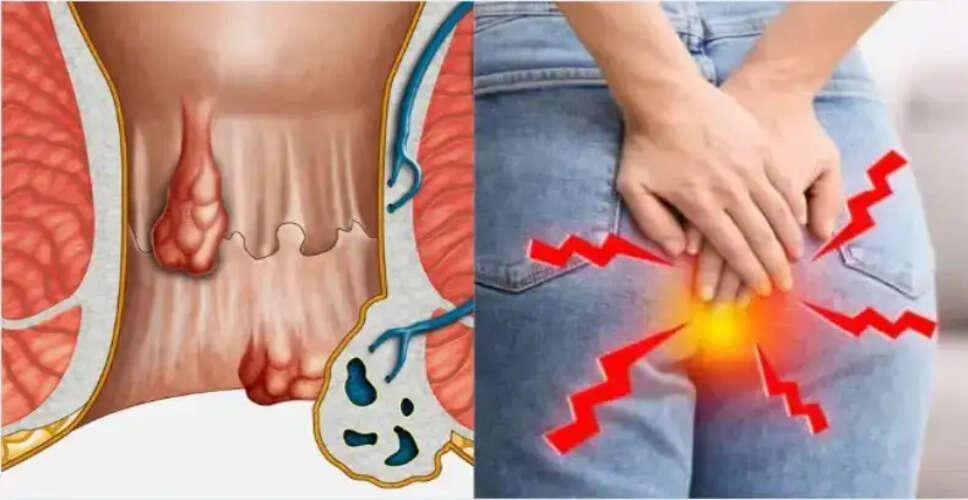 बवासीर के घरेलू उपाय: आयुर्वेद से पाएं राहत