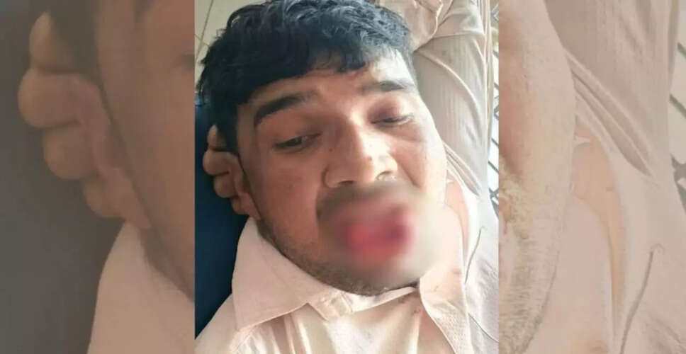 कानपुर में पूर्व प्रेमिका ने शादीशुदा युवक की जीभ काटी