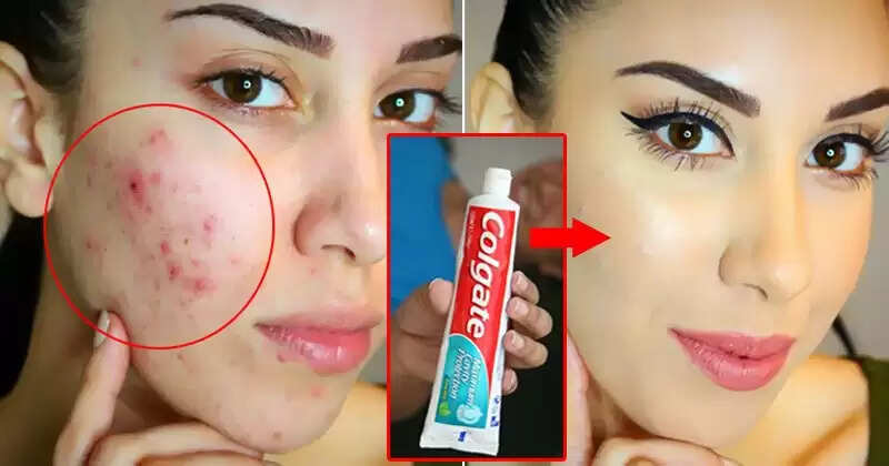मुंहासों से तात्कालिक राहत पाने के लिए टूथपेस्ट का उपयोग