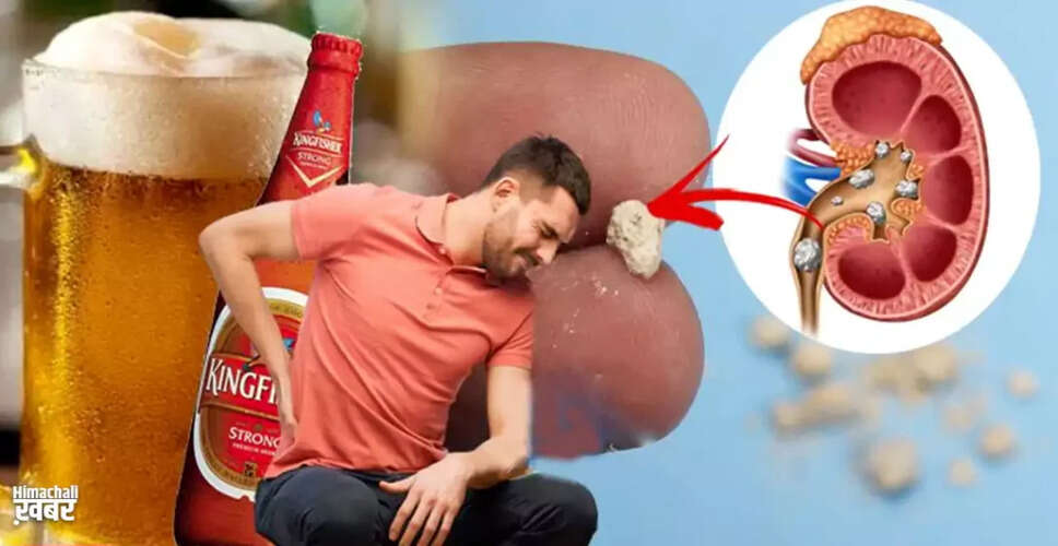 क्या बीयर पथरी के इलाज में मददगार है?