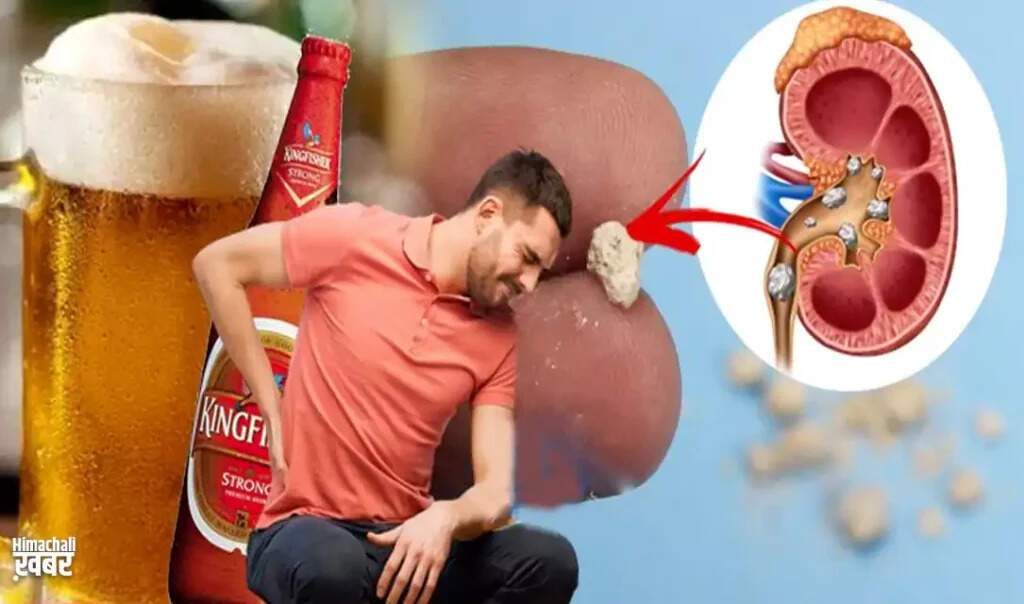 क्या बीयर पथरी के इलाज में मददगार है?