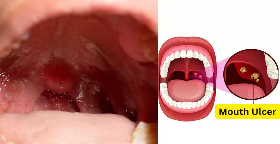 मुंह के छालों से राहत पाने के घरेलू उपाय