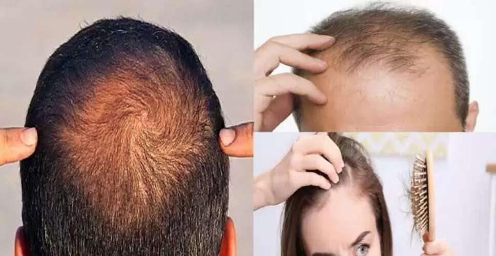बालों के झड़ने की समस्या का घरेलू उपाय