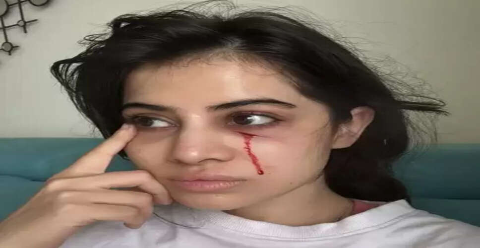 उर्फी जावेद को लगी चोट, चेहरे से बहता दिखा खून