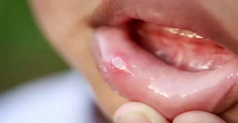 मुंह के छालों से राहत पाने के सरल घरेलू उपाय