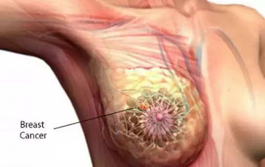 नींद, तनाव और मोटापा: ब्रेस्ट कैंसर के जोखिम को कैसे बढ़ाते हैं?