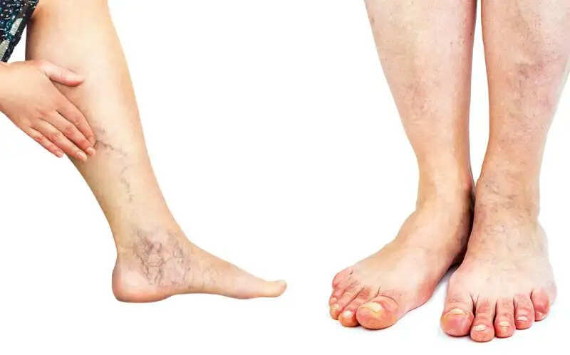 नस चढ़ने की समस्या: कारण और समाधान