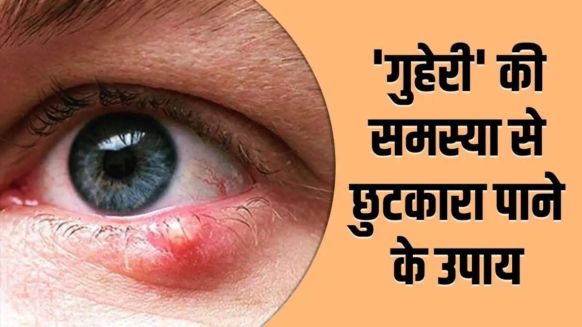 Eye Stye Causes and Prevention: आंख में गुहेरी या बिलनी की समस्या बहुत गंभीर हो सकती है, जानें इसके कारण और बचाव।